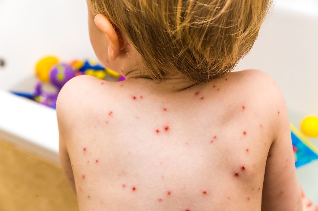 Chickenpox Facts Diseases Of The World WorldAtlas