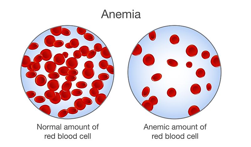 Anemia in Children - Prevalence Around the World - WorldAtlas