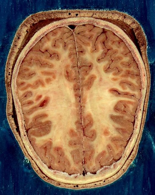 Cortical folds and white matter in horizontal bisection of head