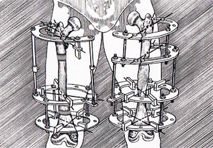 An Ilizarov apparatus fitted to a patient's leg.
